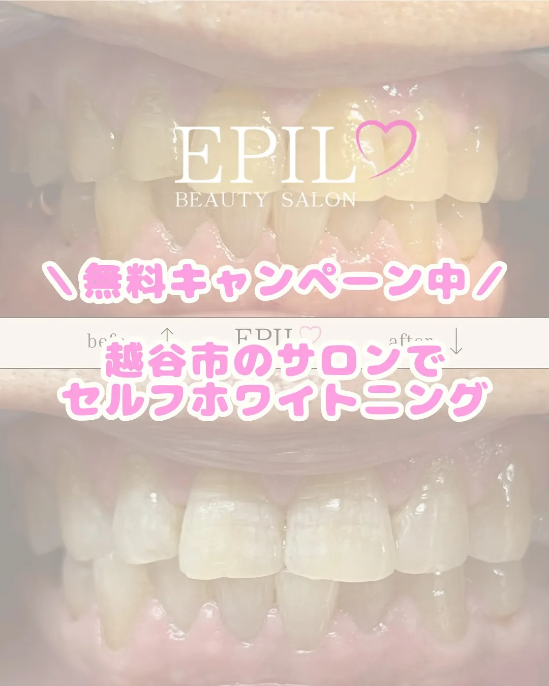 🦷✨ホワイトニングで笑顔に自信を✨🦷