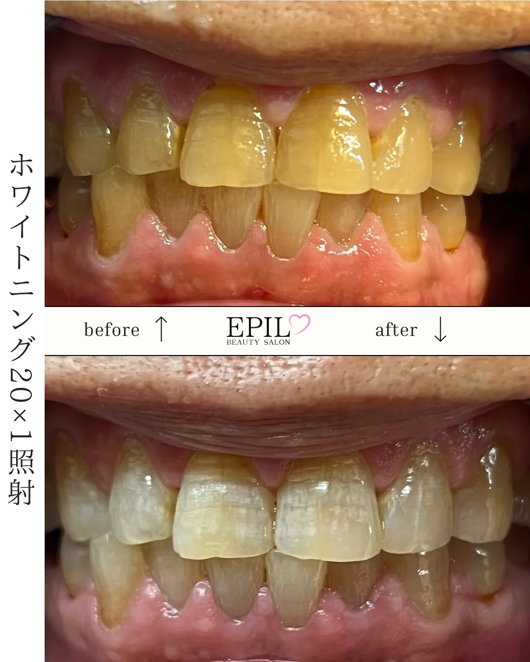 🦷✨ホワイトニングで笑顔に自信を✨🦷