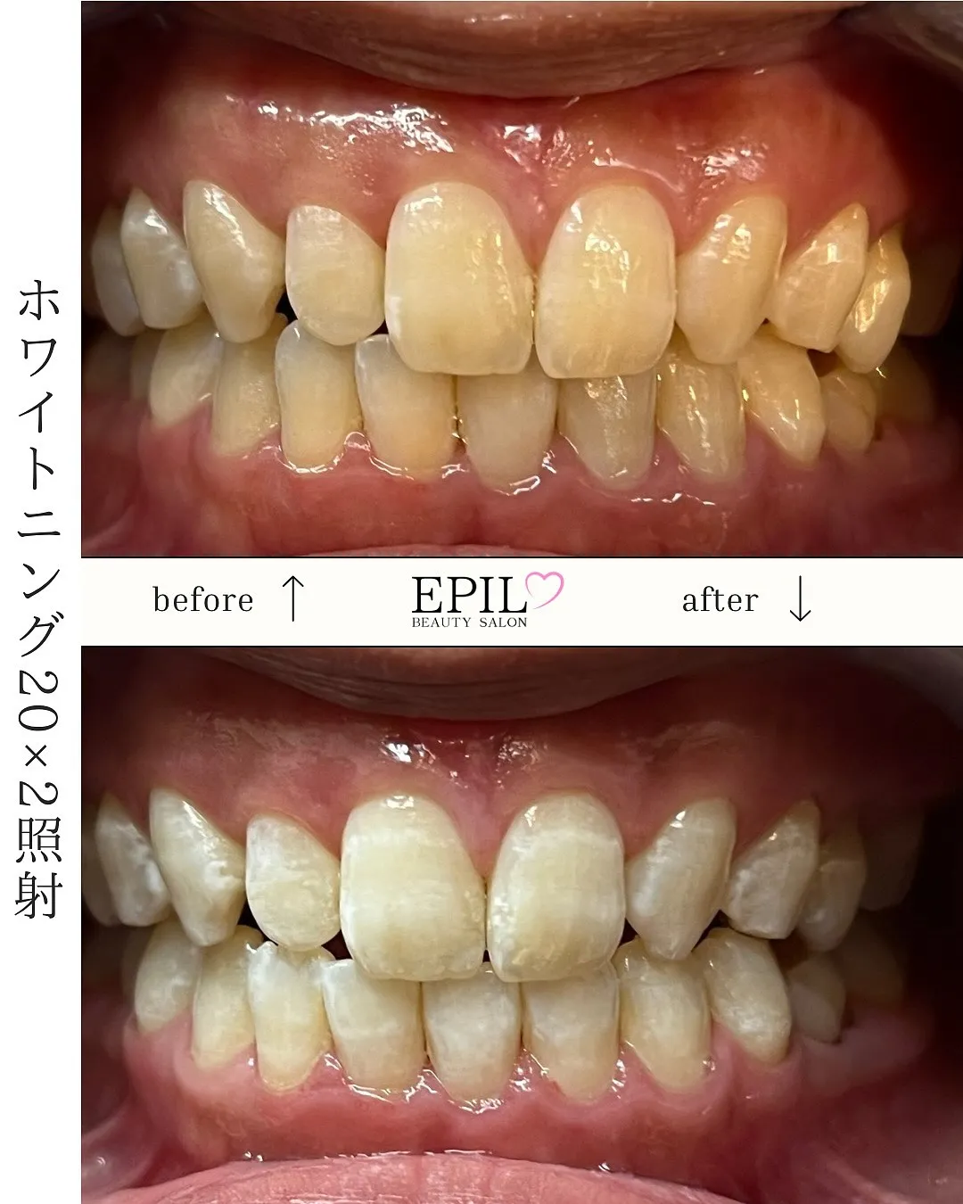 🦷✨ホワイトニングで笑顔に自信を✨🦷