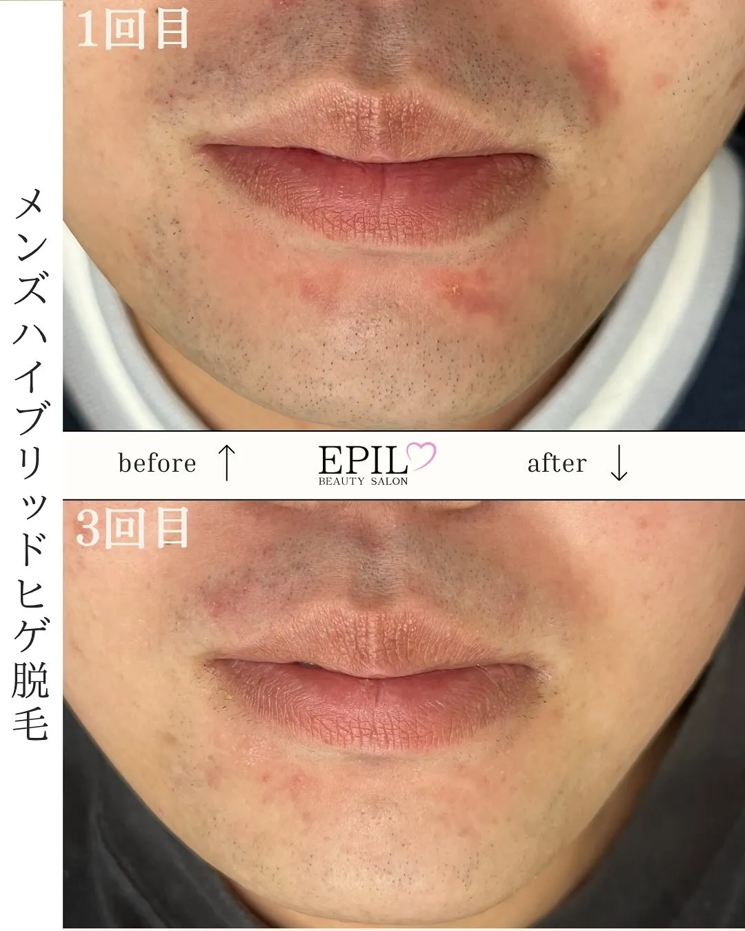 📸【ハイブリッド脱毛 Before & After】