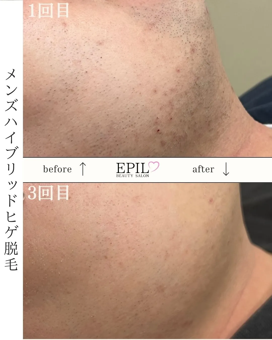 📸【ハイブリッド脱毛 Before & After】