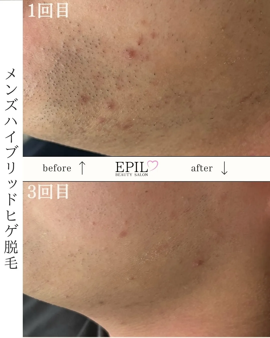 【ヒゲ脱毛 Before→After📸】