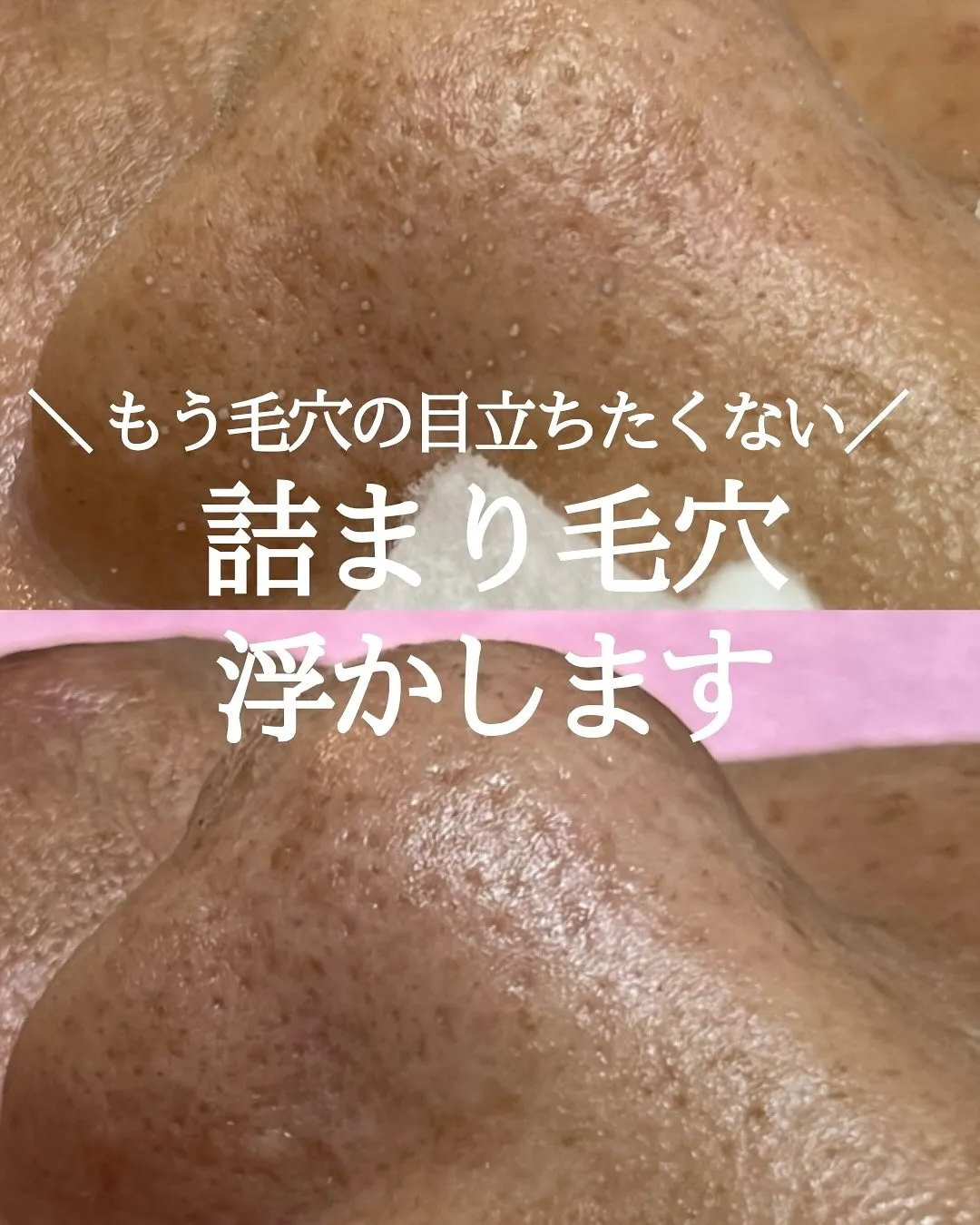 ✨EPILの毛穴洗浄✨