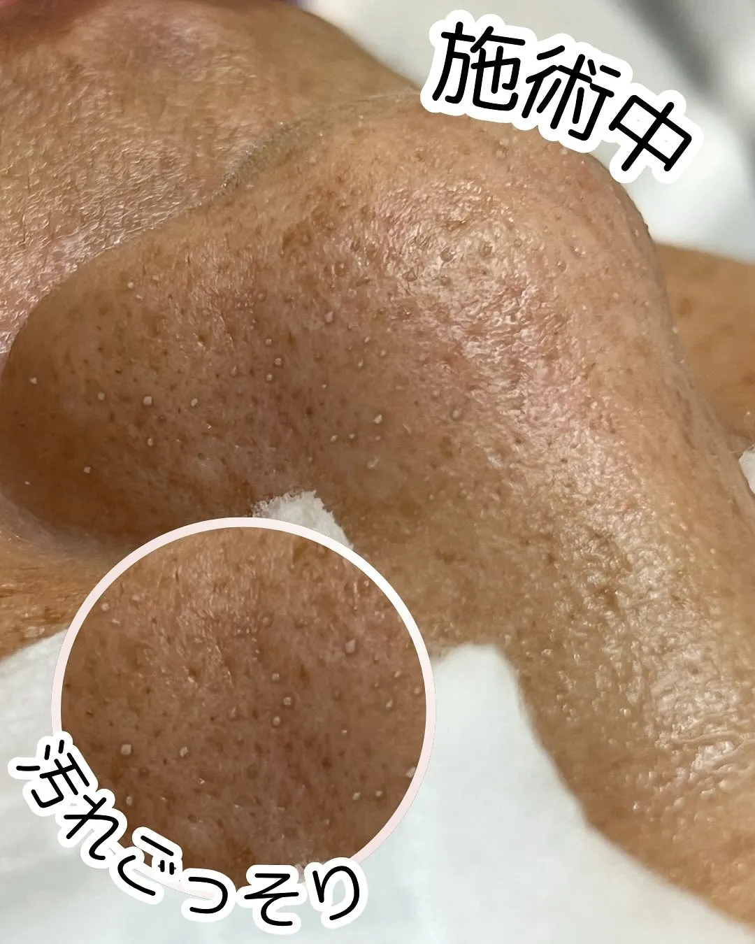 ✨EPILの毛穴洗浄✨