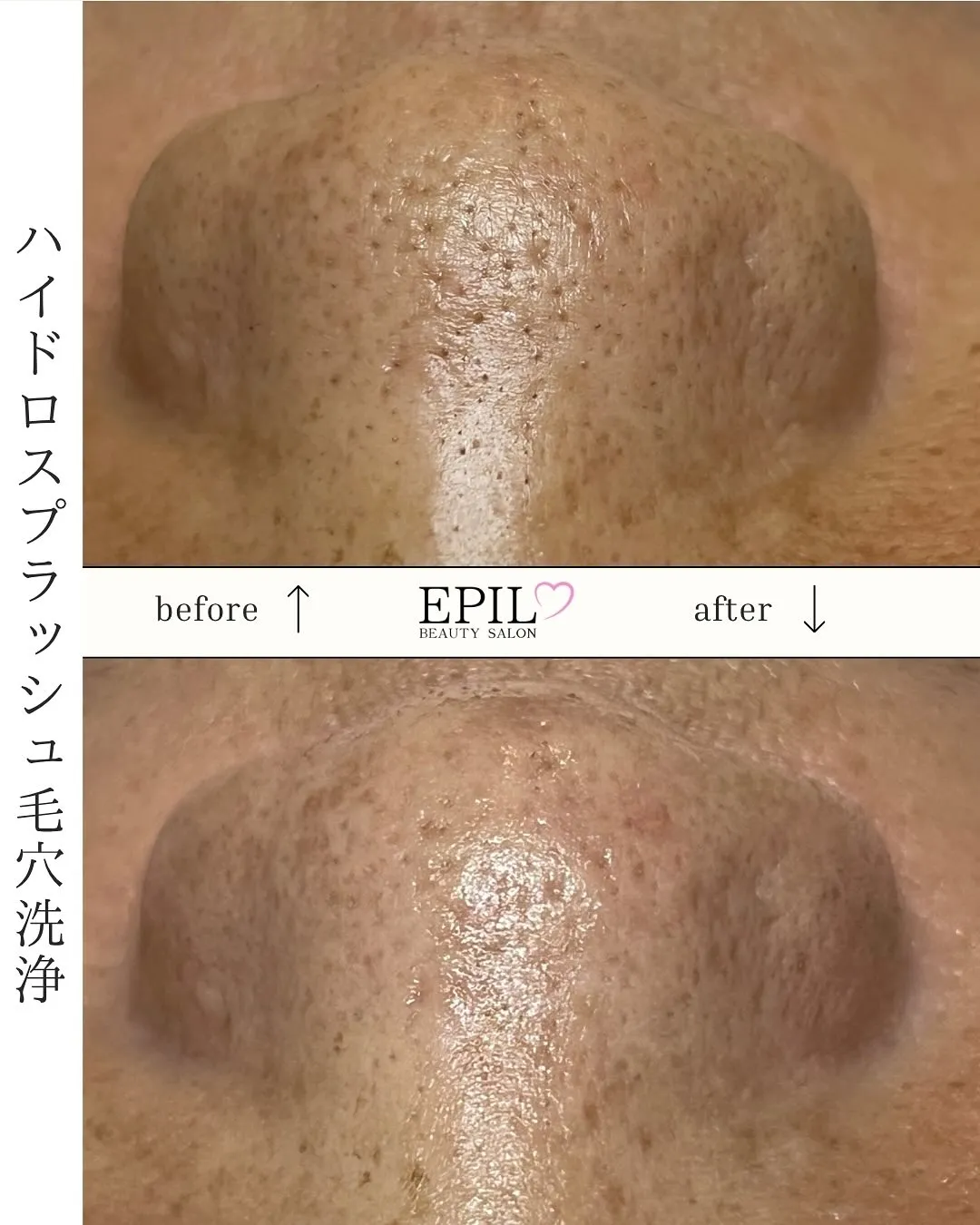 ✨EPILの毛穴洗浄✨