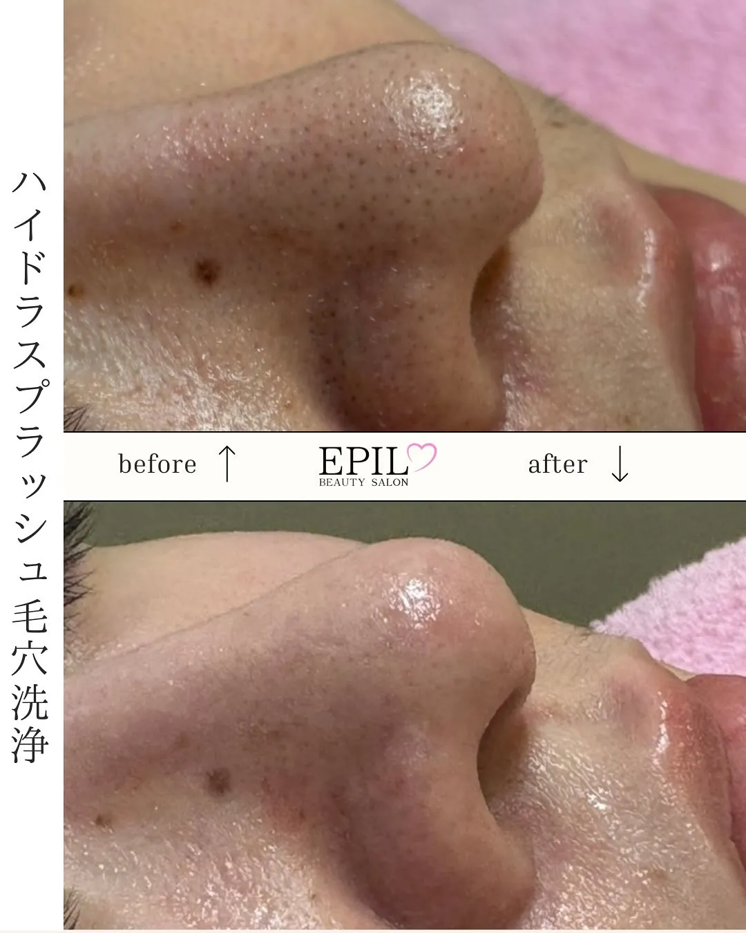 📸毛穴スッキリBefore→After✨