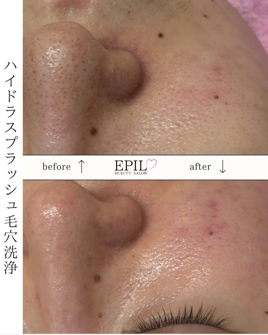 📸毛穴スッキリBefore→After✨