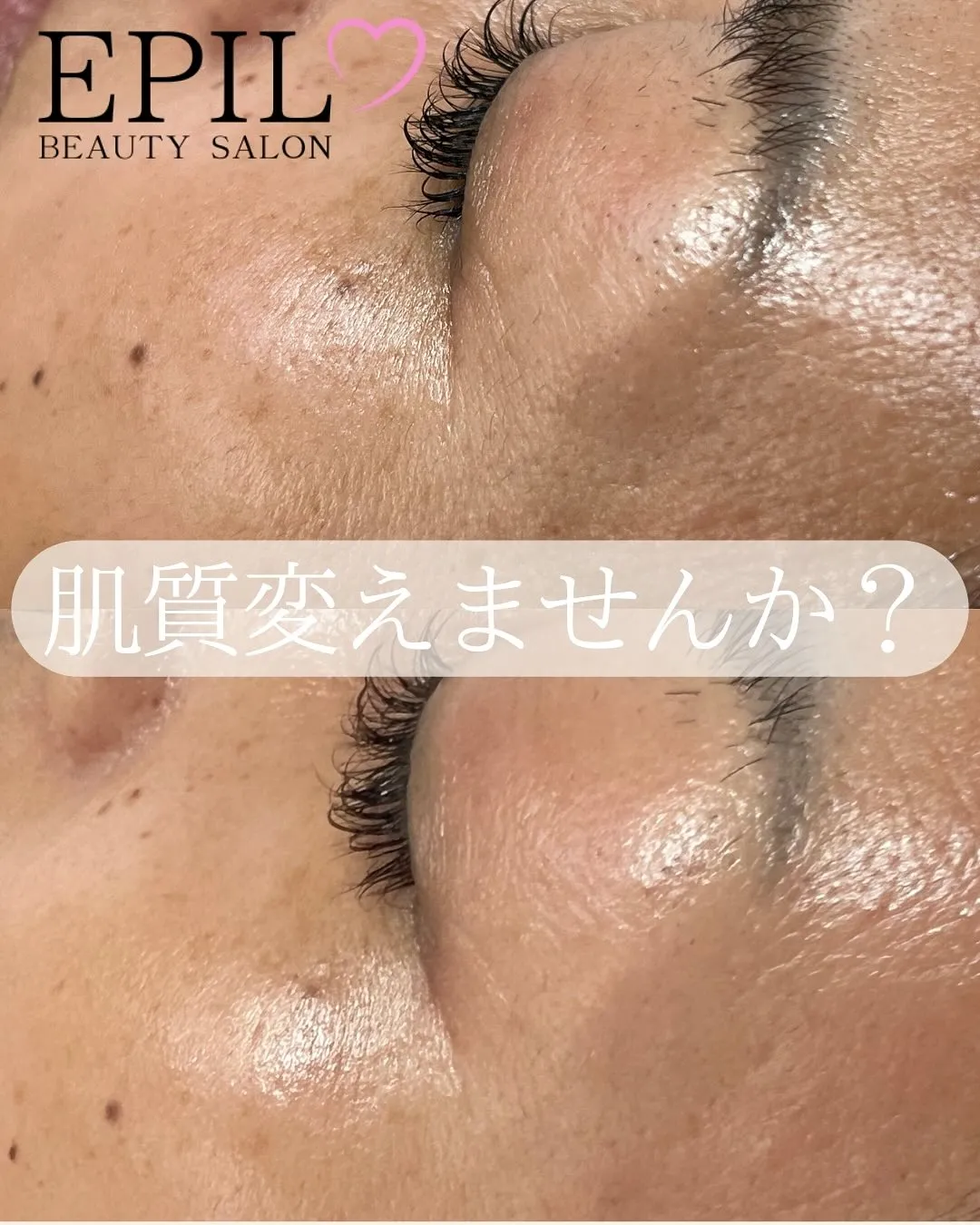 ✨\ 「毛穴の開きもたるみも…リセット♡/✨