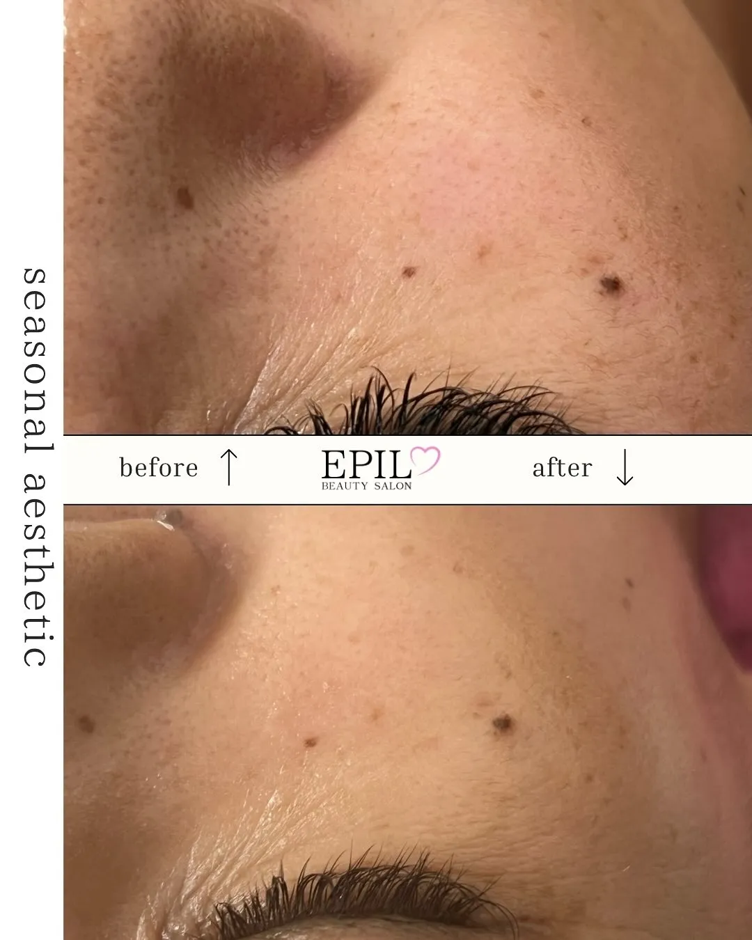 ✨\ 「毛穴の開きもたるみも…リセット♡/✨