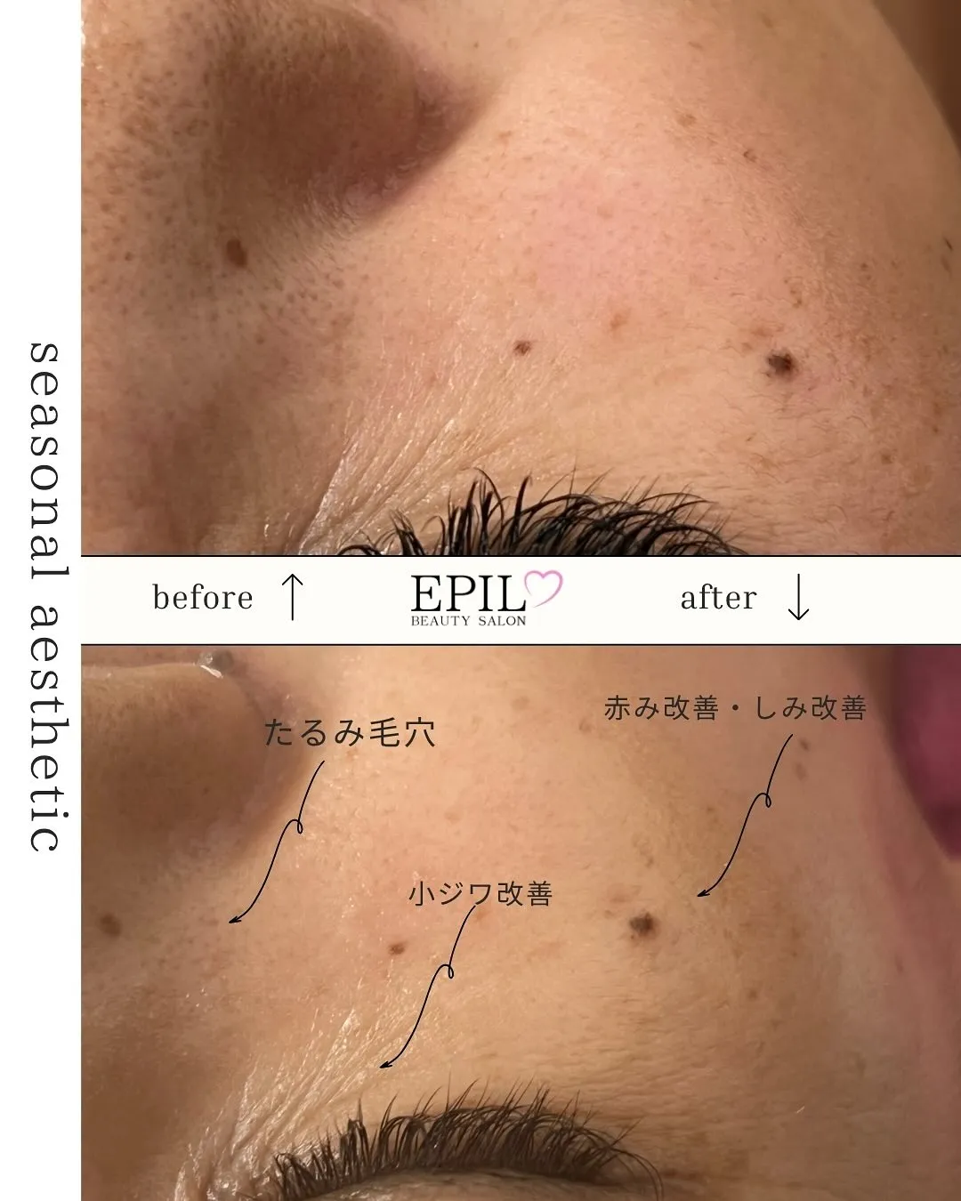 ✨\ 「毛穴の開きもたるみも…リセット♡/✨