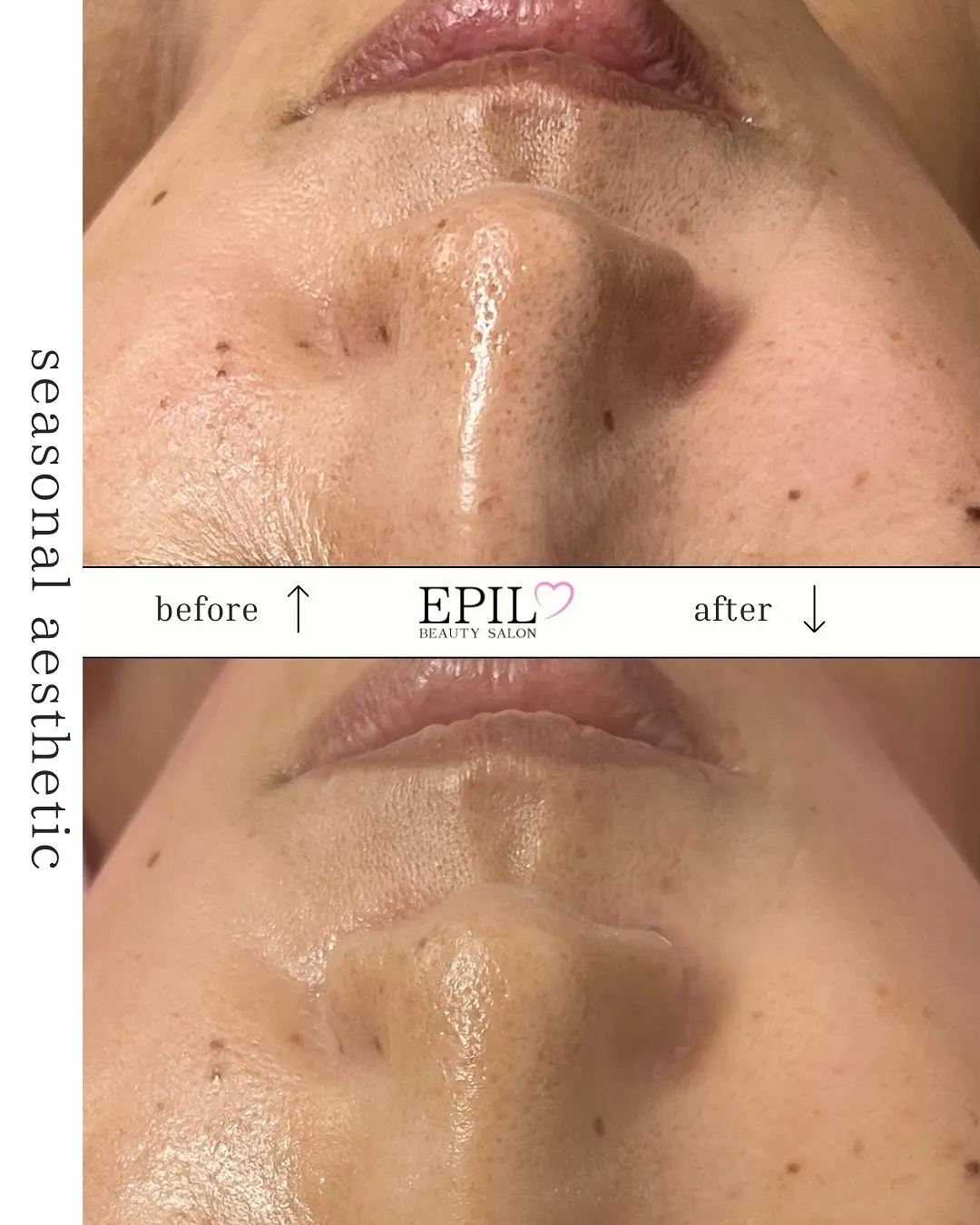 ✨\ 「毛穴の開きもたるみも…リセット♡/✨