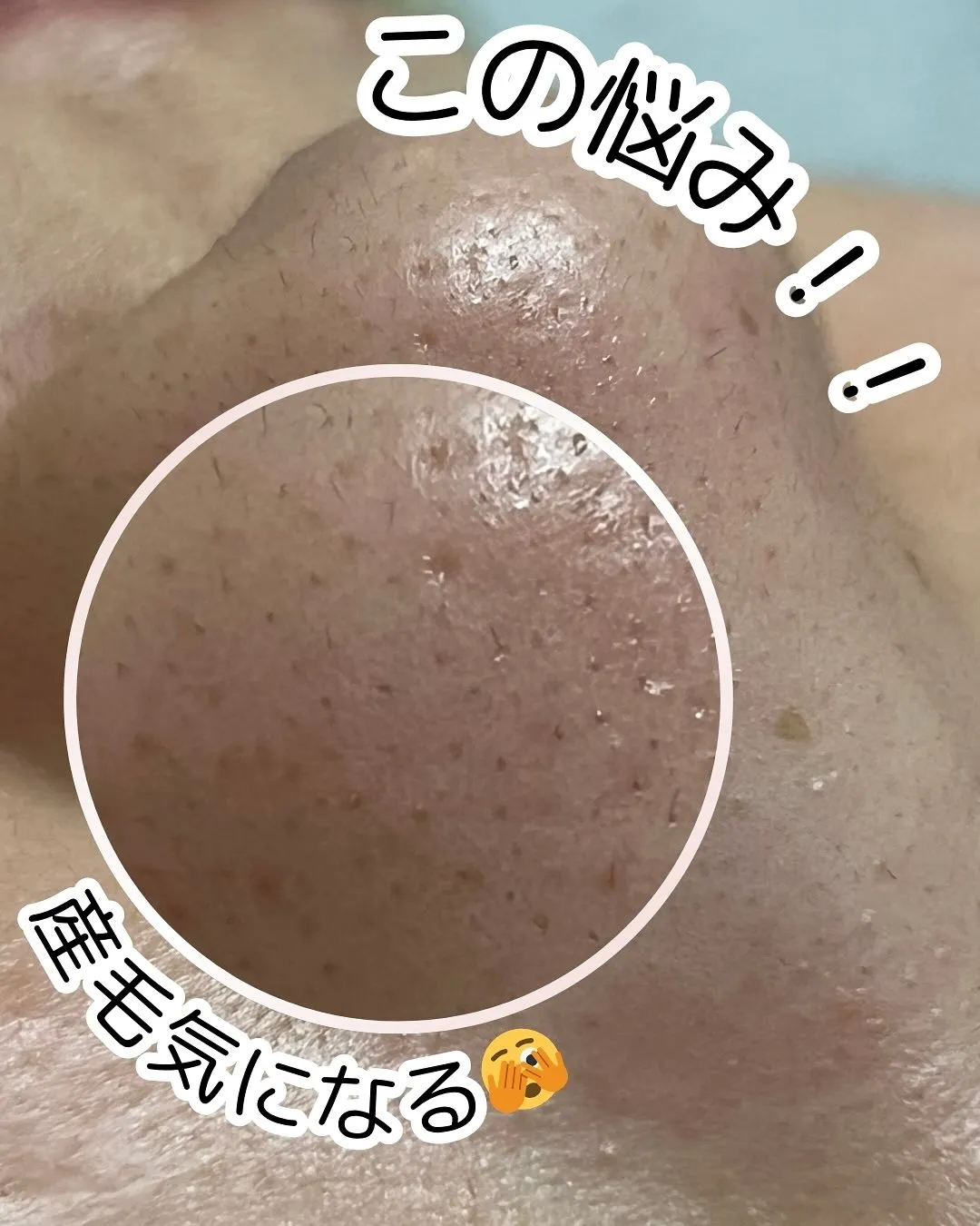 毛穴の黒ずみ、ザラつき…