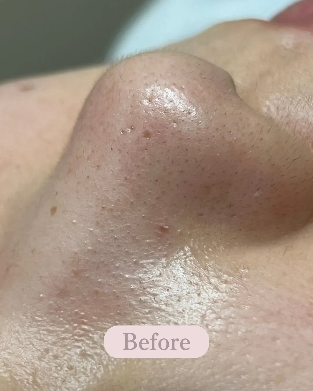 毛穴の黒ずみ、ザラつき…