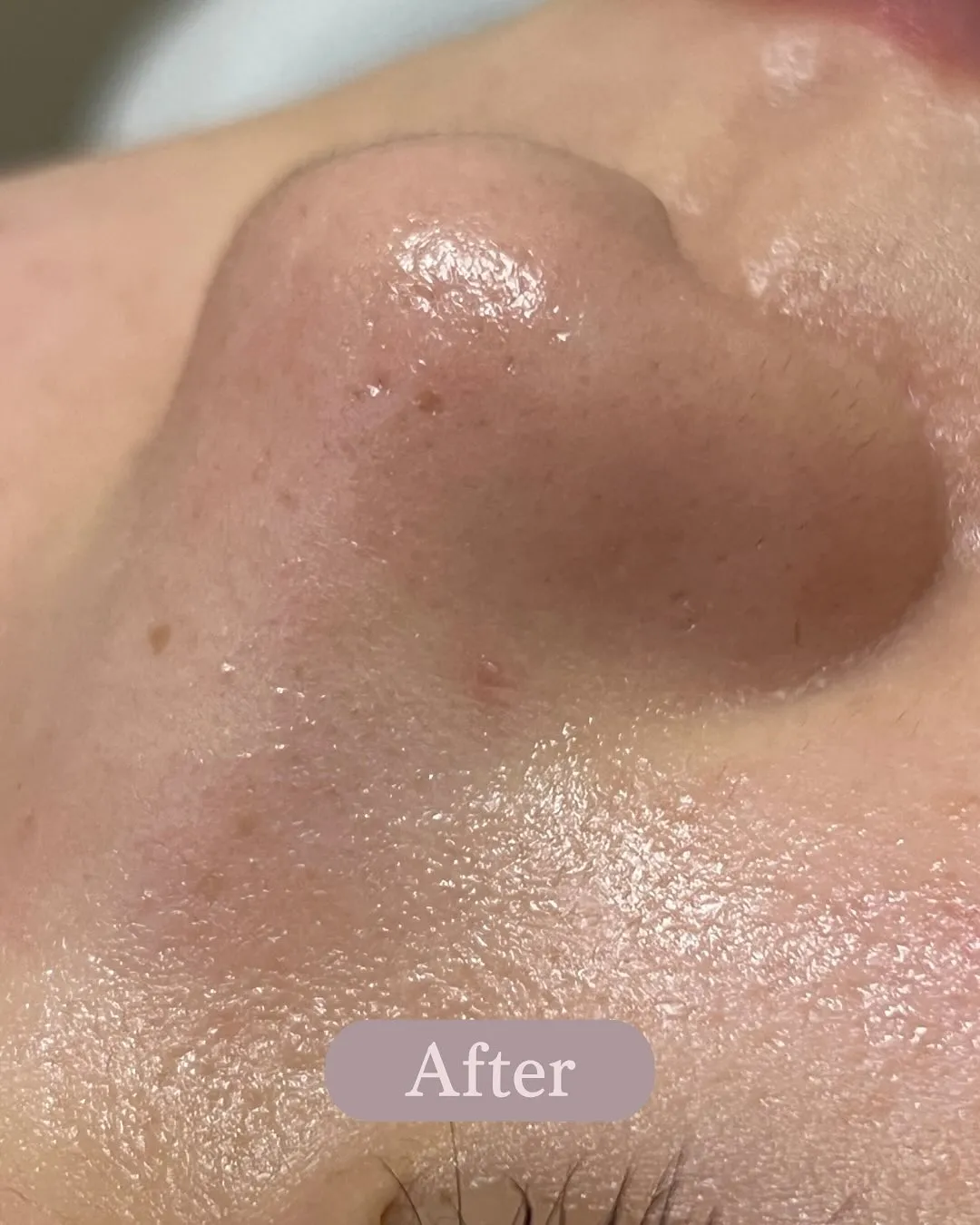 毛穴の黒ずみ、ザラつき…