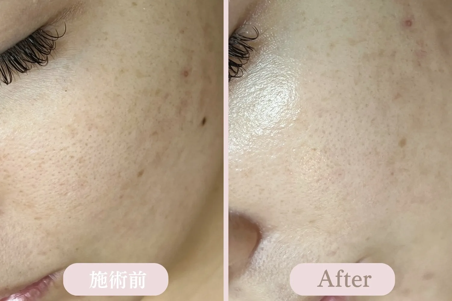 ディープクリアスキン毛穴洗浄