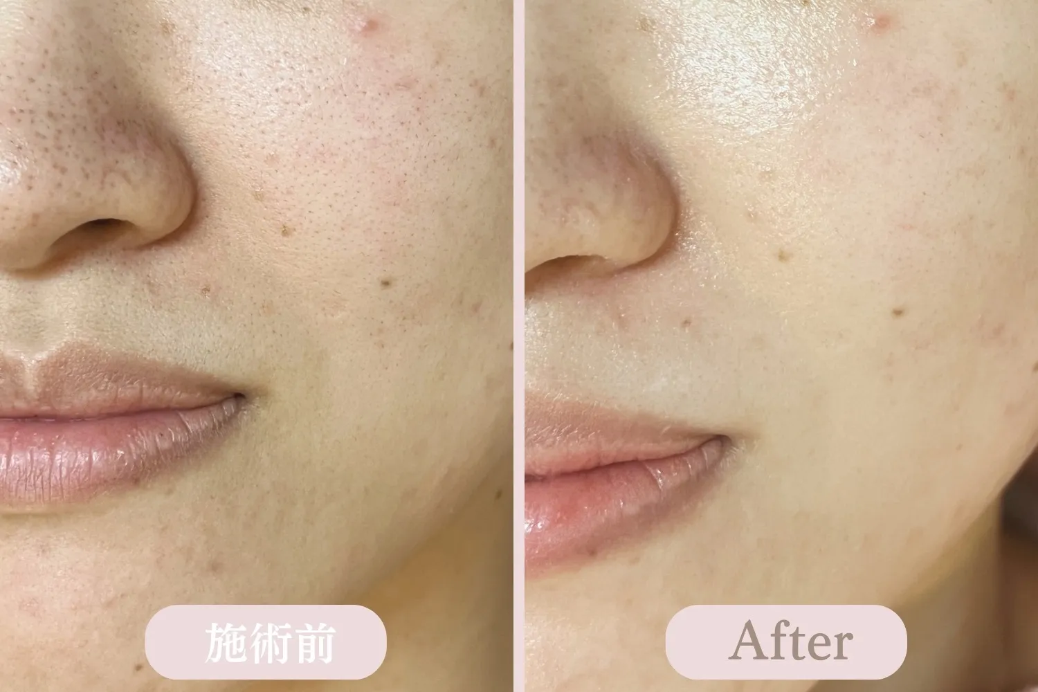 ディープクリアスキン毛穴洗浄