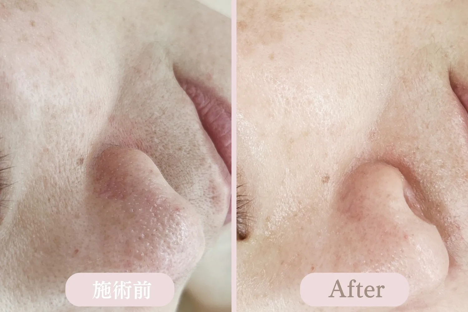 ディープクリアスキン毛穴洗浄