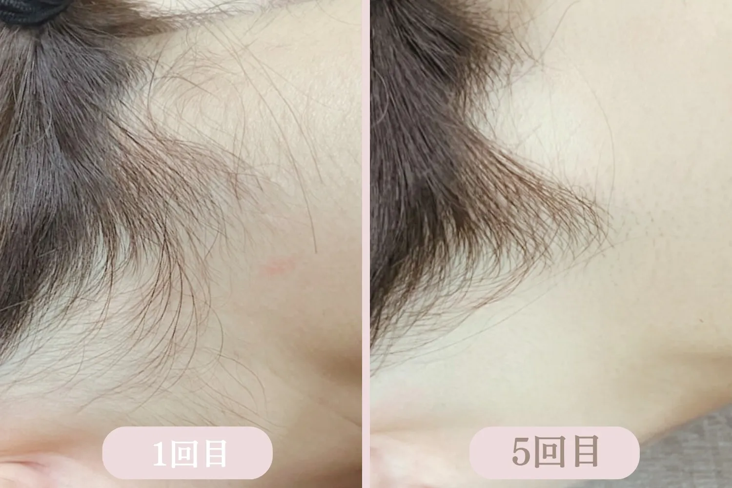 次世代脱毛機【LUMIX-A9】