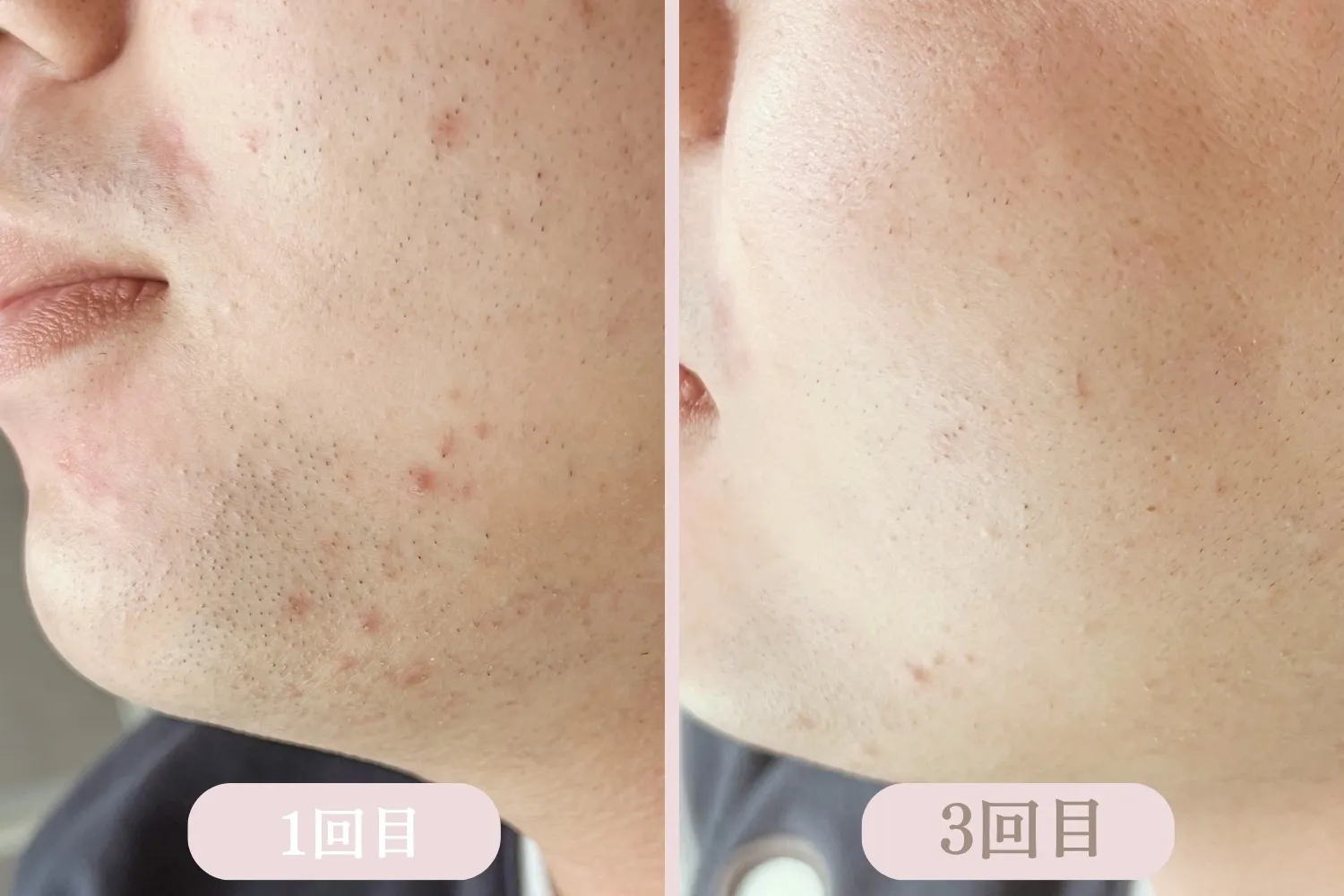 次世代脱毛機【LUMIX-A9】