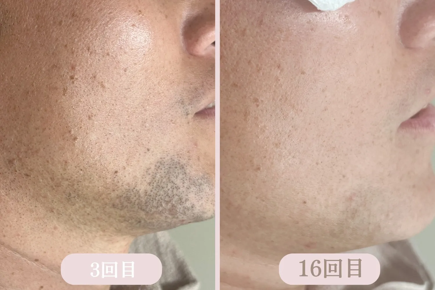 次世代脱毛機【LUMIX-A9】