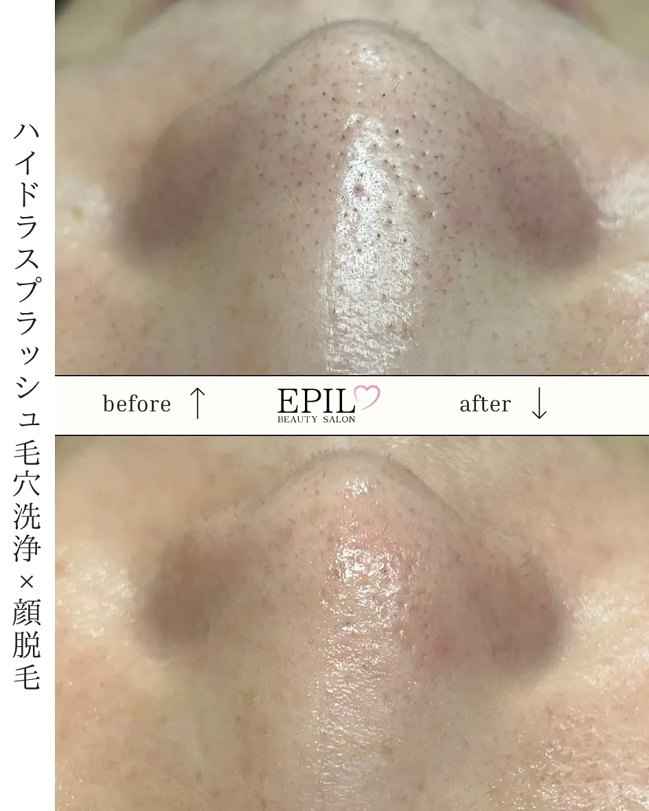 📸【毛穴洗浄+顔脱毛】Before→After✨