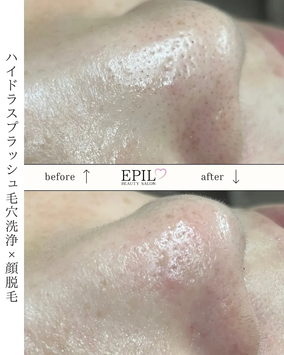 📸【毛穴洗浄+顔脱毛】Before→After✨