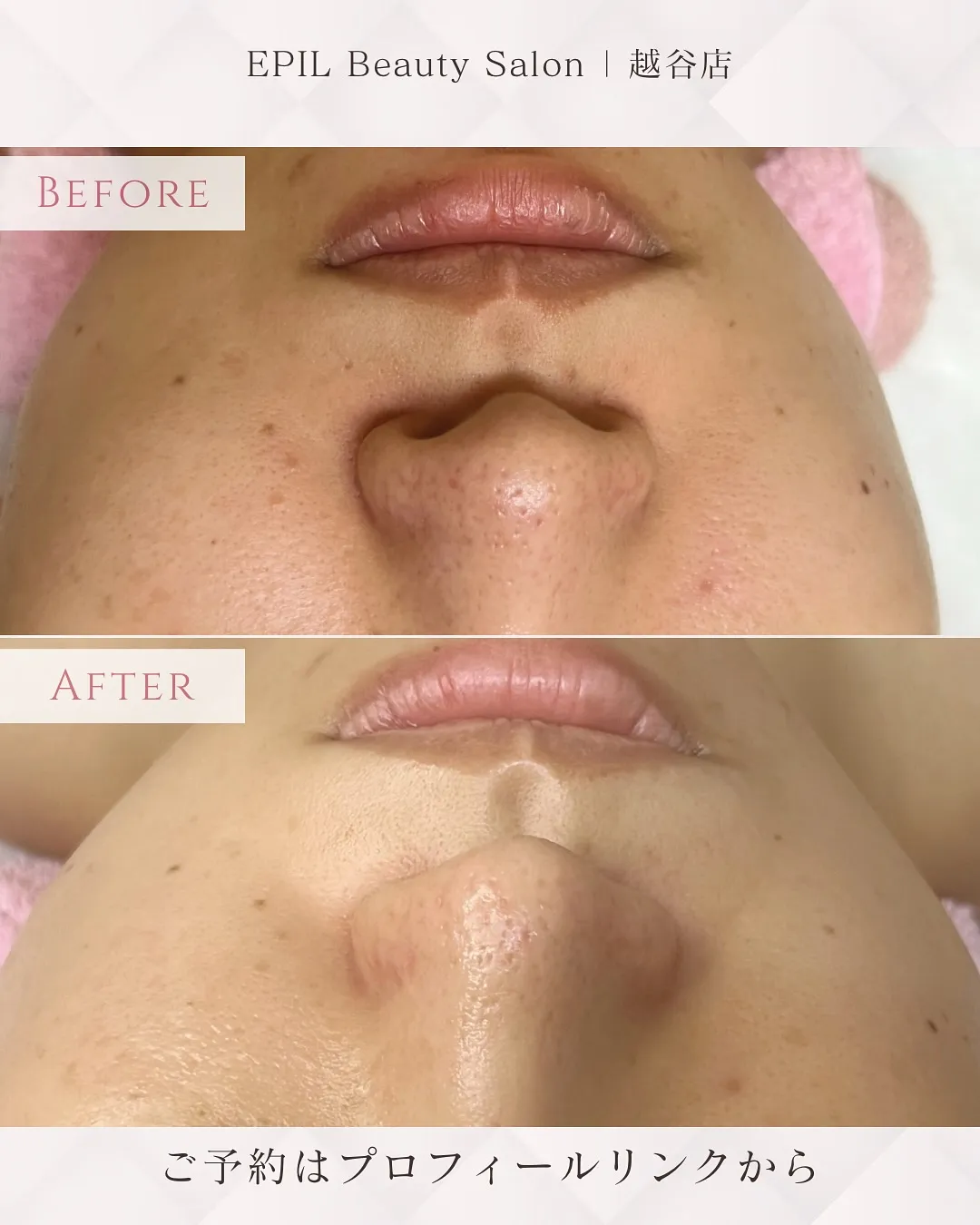 📸【LHALA Silk Skin 症例】