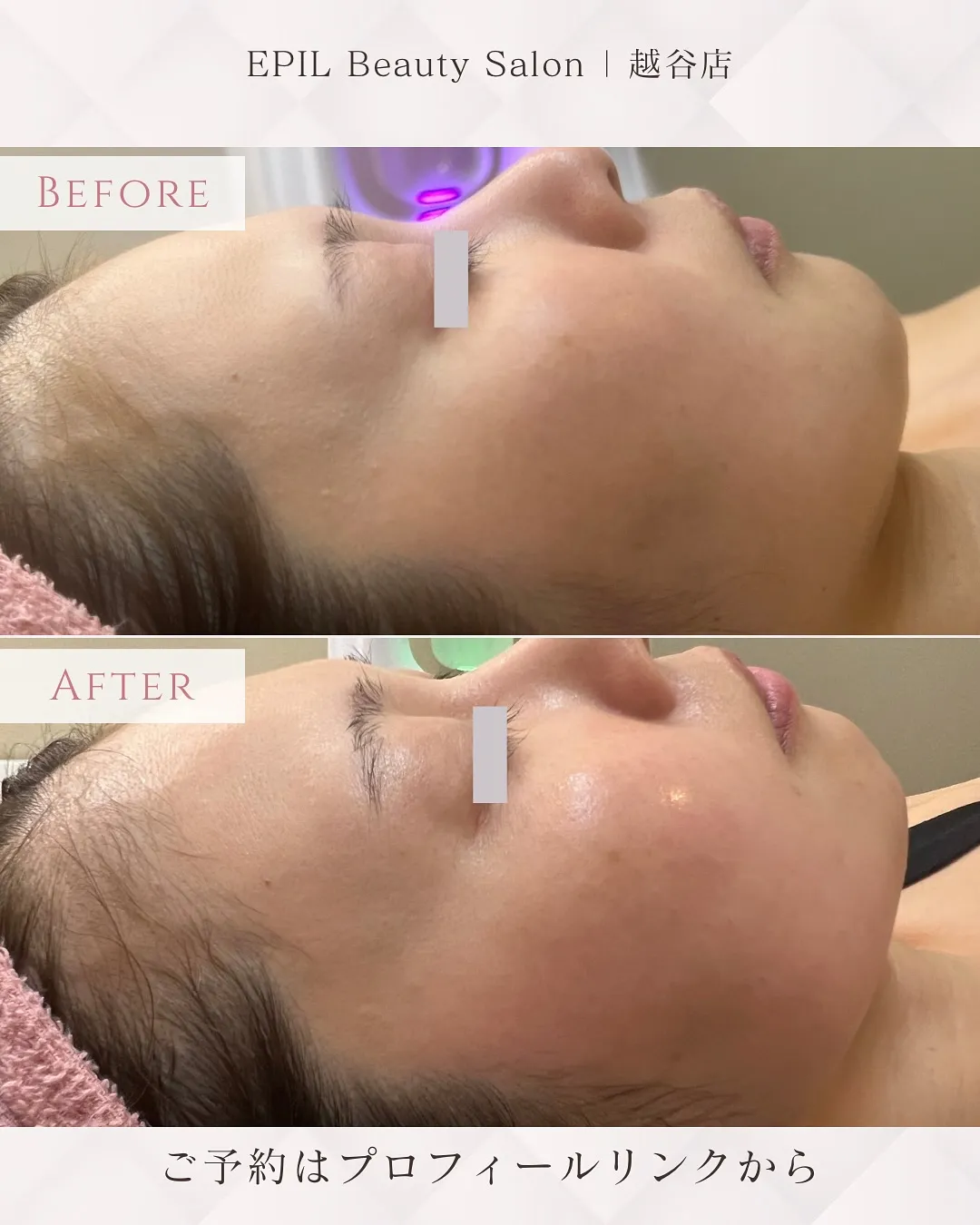 📸【Silk Skin 症例紹介】