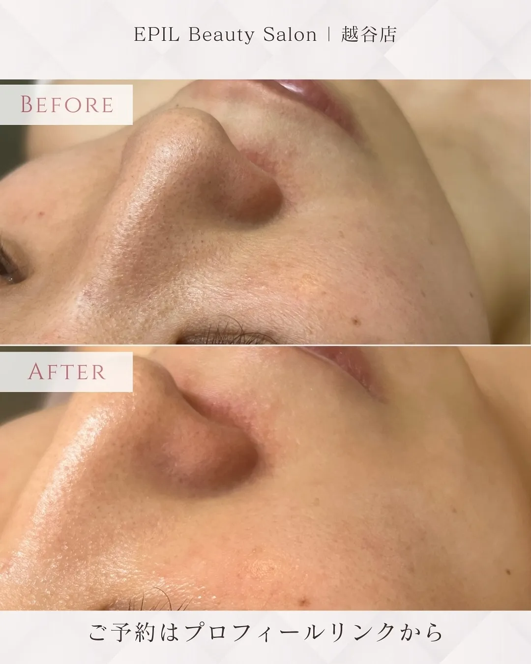 📸【LHALA Silk Skin 症例】