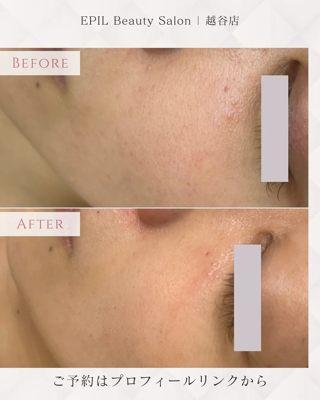 📸【LHALA Silk Skin 症例】