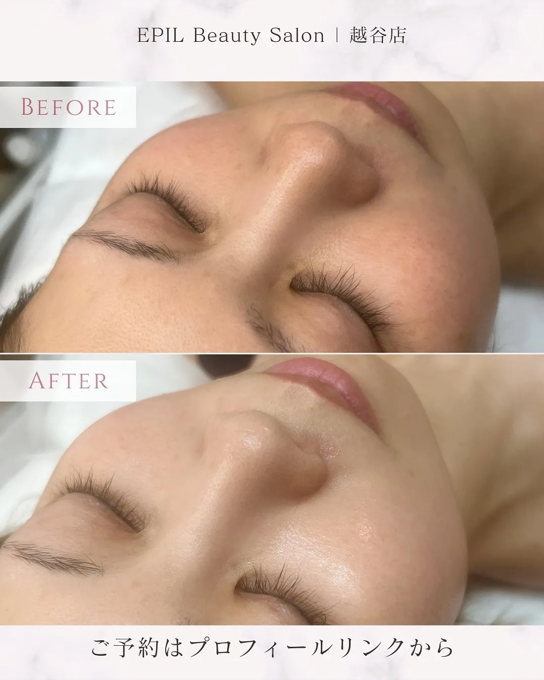 📸【Silk Skin 症例紹介】