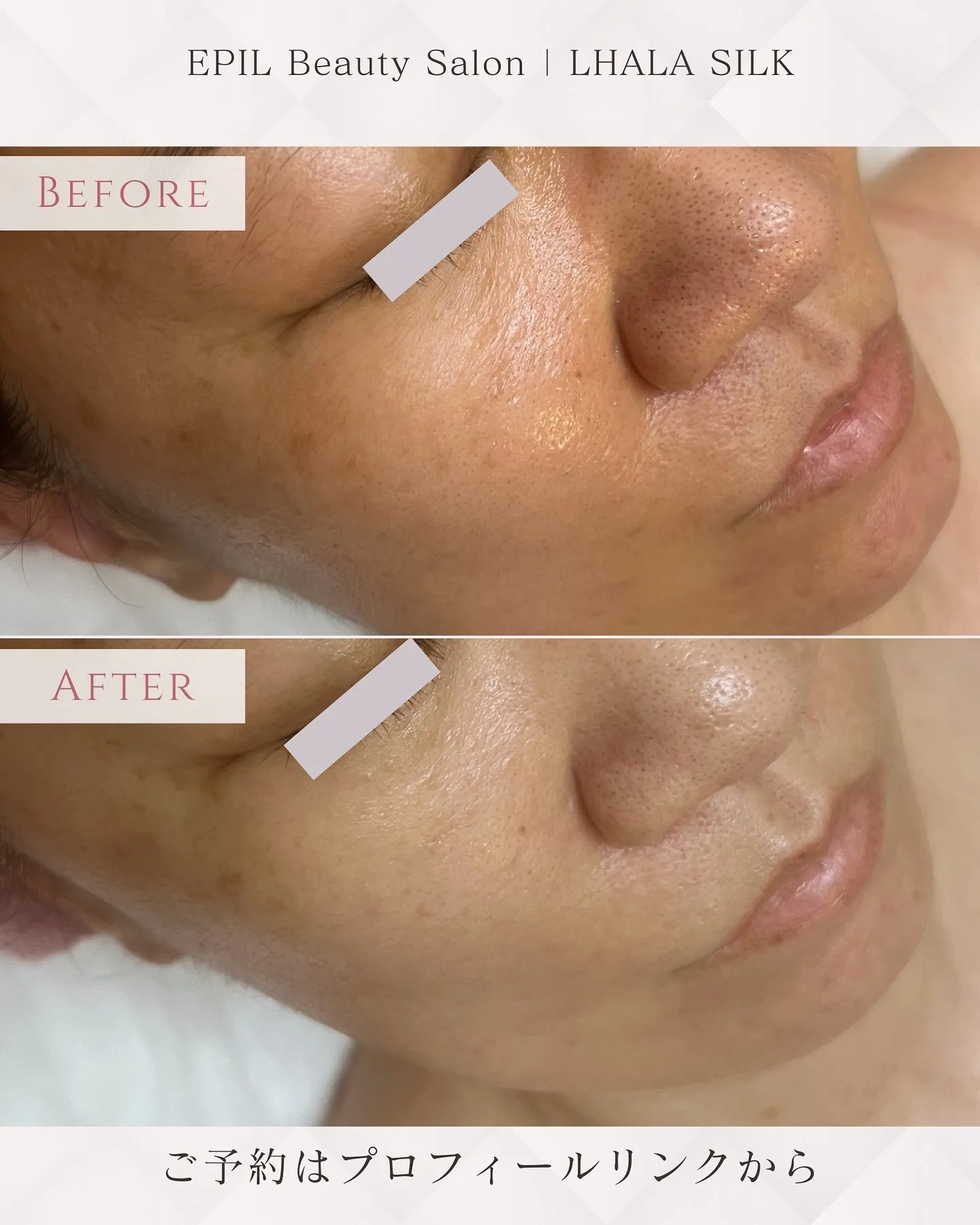 📸【Silk Skin 症例紹介】