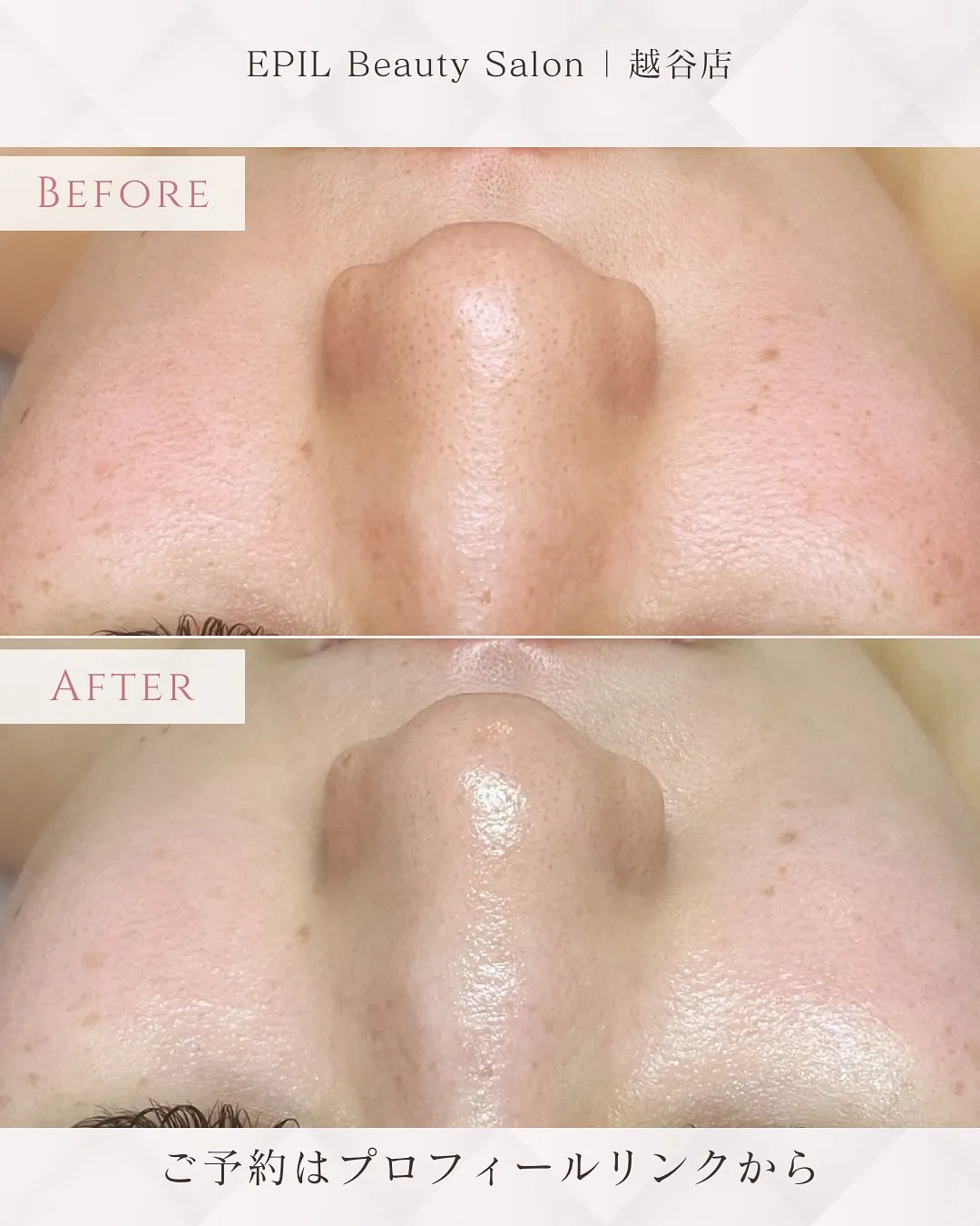 「DEEPクリアスキン CARENA」