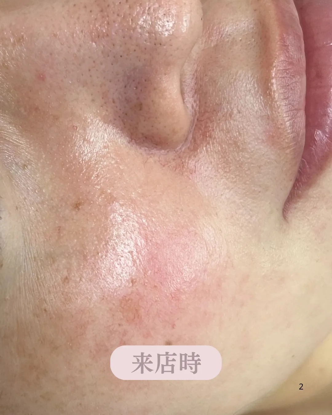 \ララピール*3回ビフォーアフター/✨/