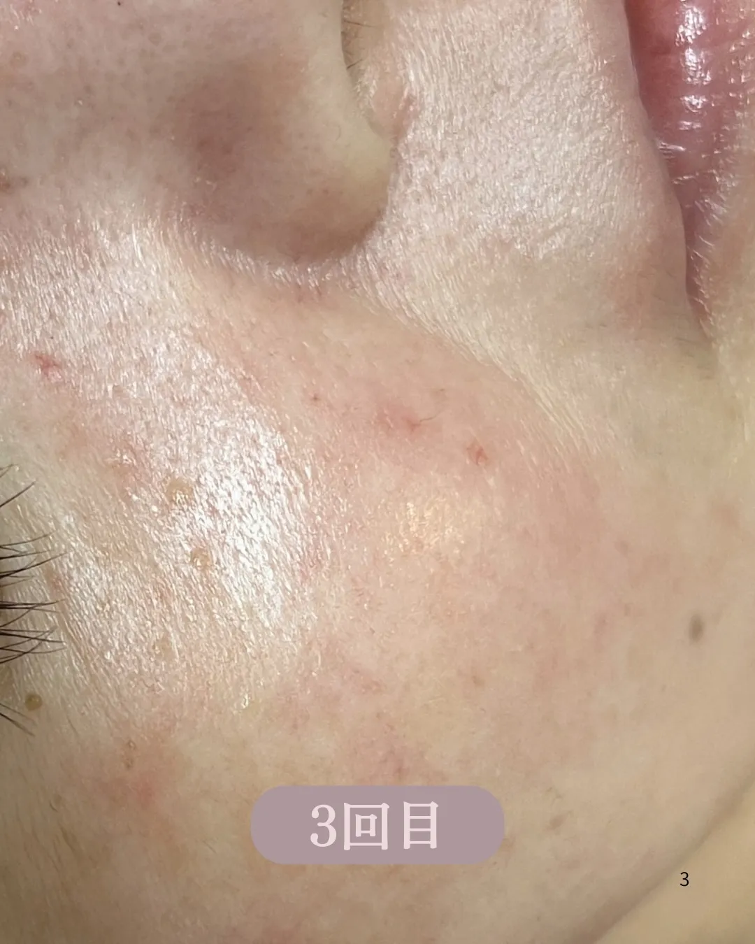 \ララピール*3回ビフォーアフター/✨/