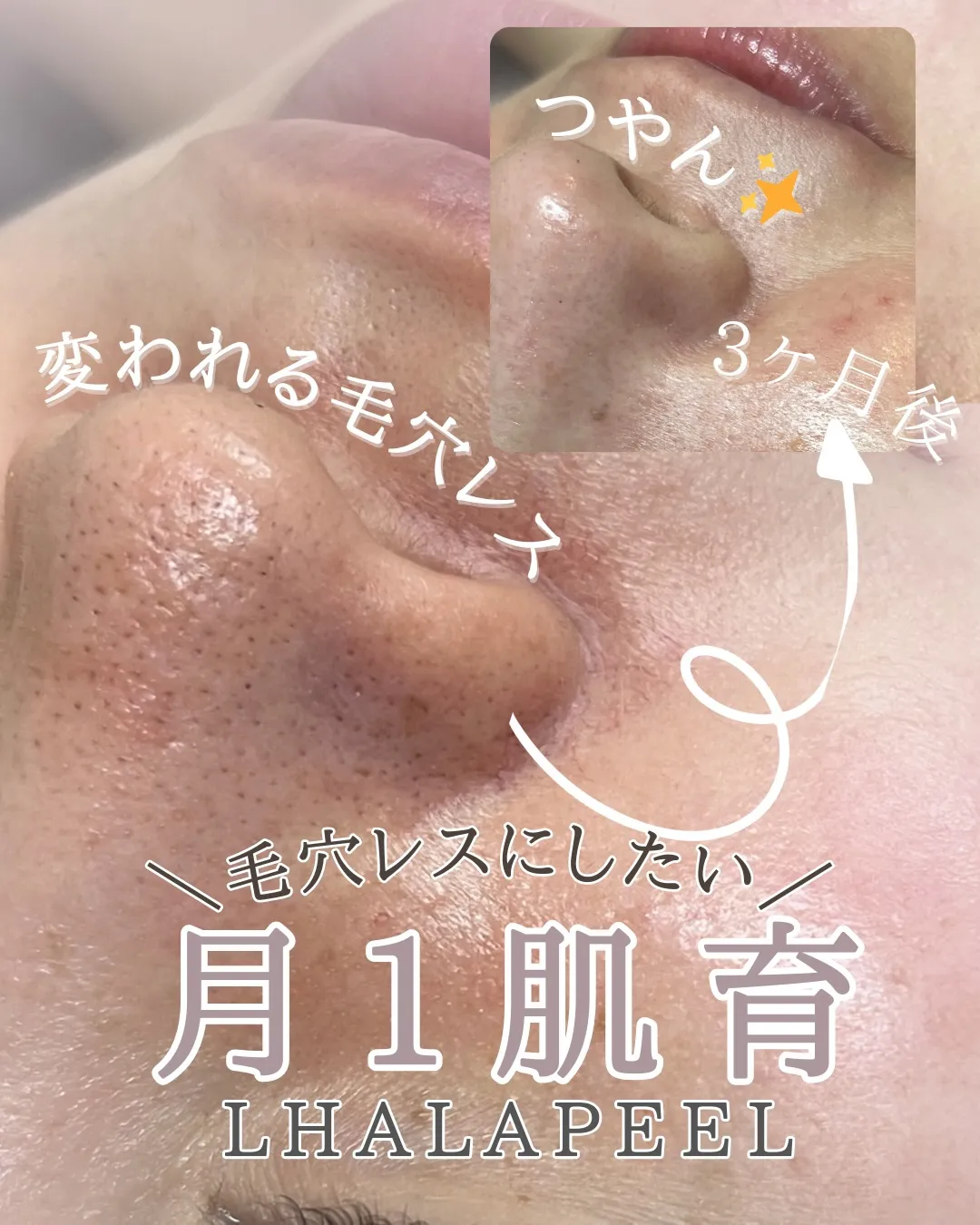 \ララピール*3回ビフォーアフター/✨/