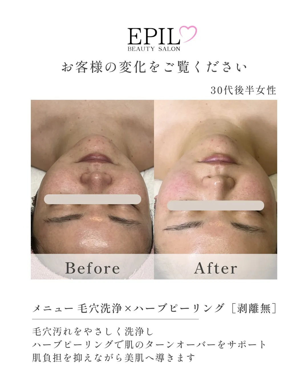 【くすみ・色ムラの原因3つ】