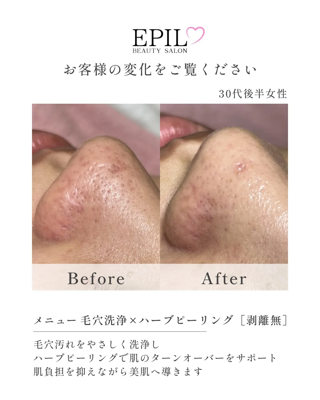 【なんで毛穴ってすぐ詰まるの?】