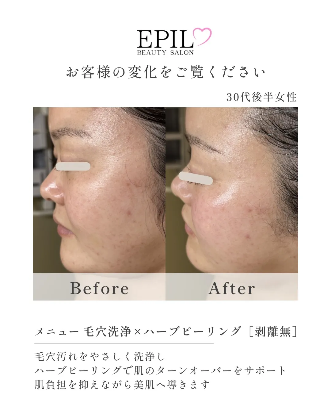 【肌がザラザラ?それ角栓です】