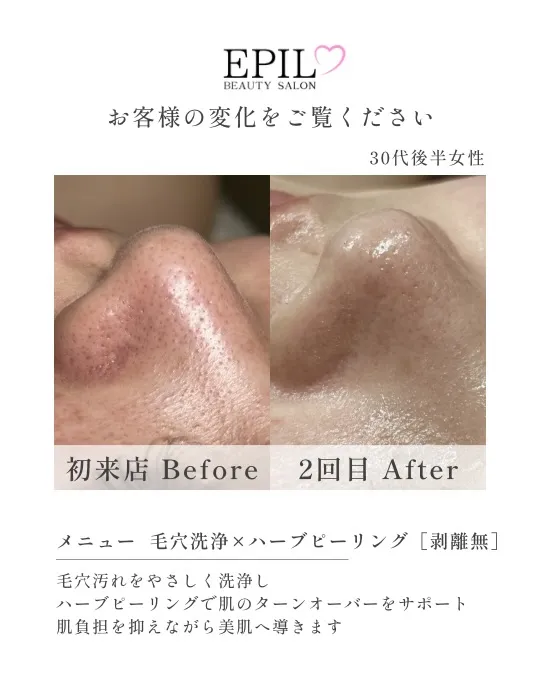 【毛穴改善の経過】
