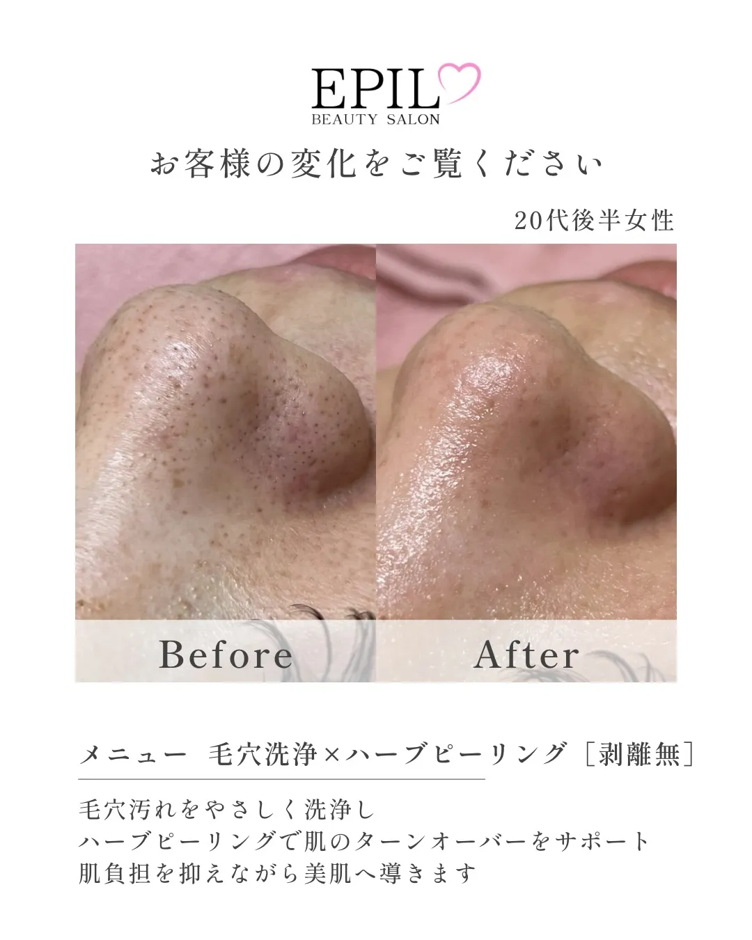 【ハーブピーリング MENU🌿】