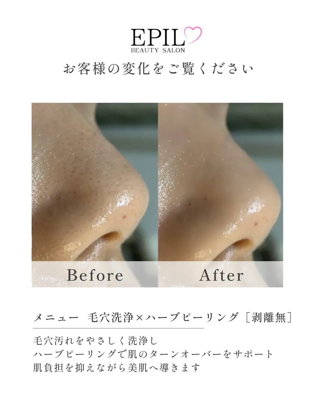 【毛穴の黒ずみ・ざらつき・開きにお悩みの方へ】