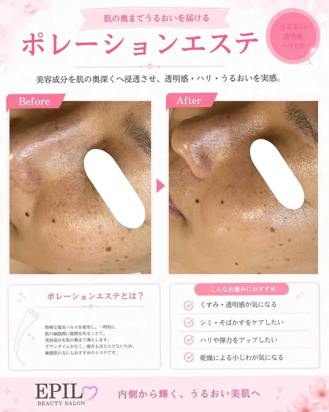 ✨ポレーションエステ施術✨