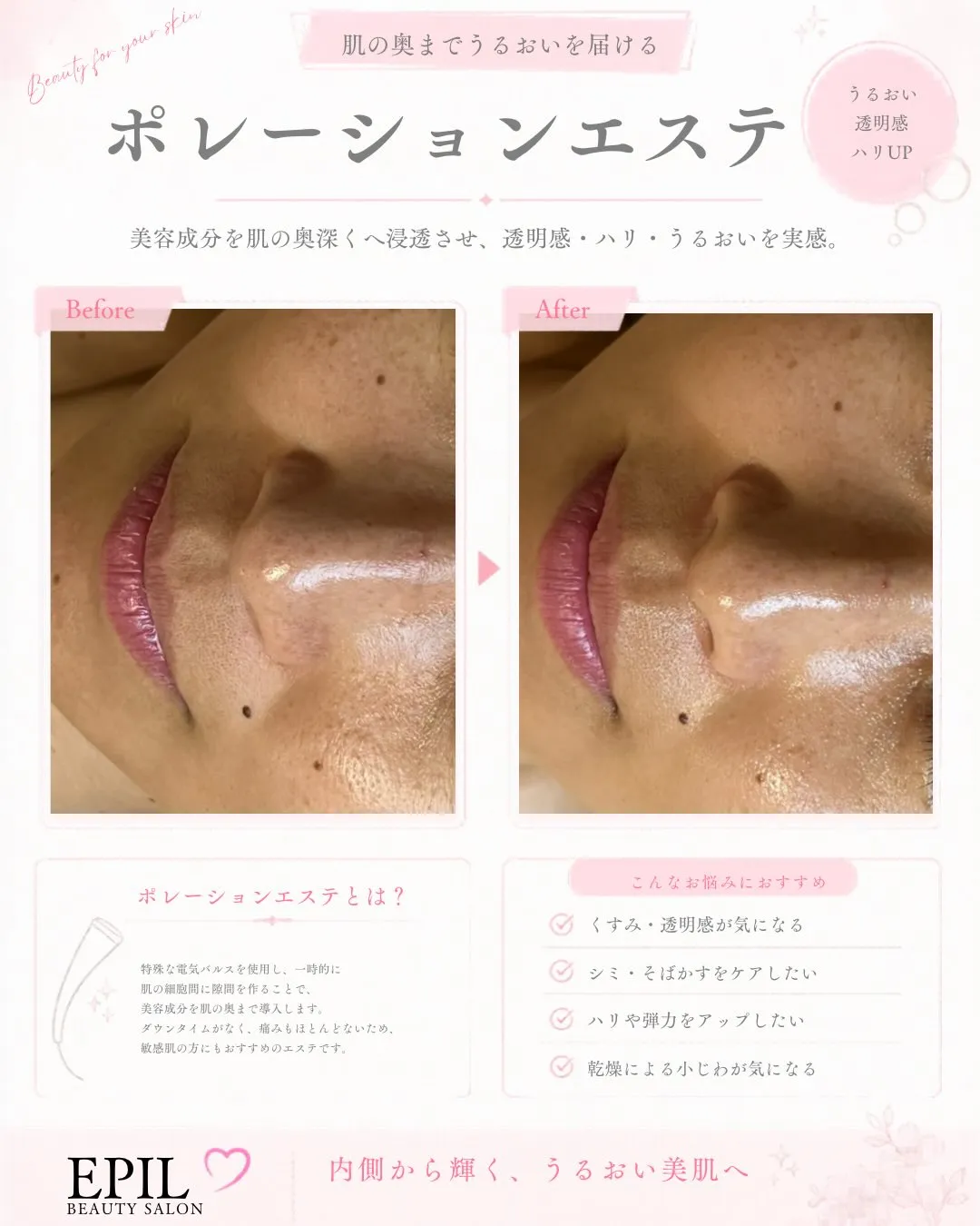 ✨ポレーションエステ ビフォーアフター✨