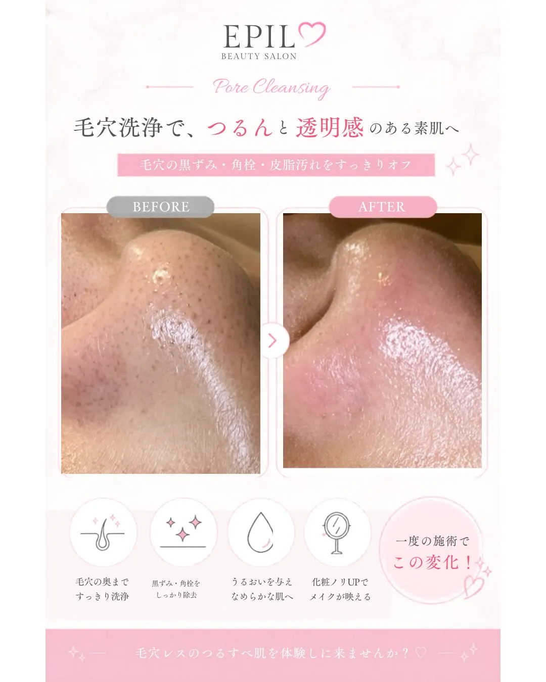 ✨黒ずみ毛穴にお悩みの方へ✨
