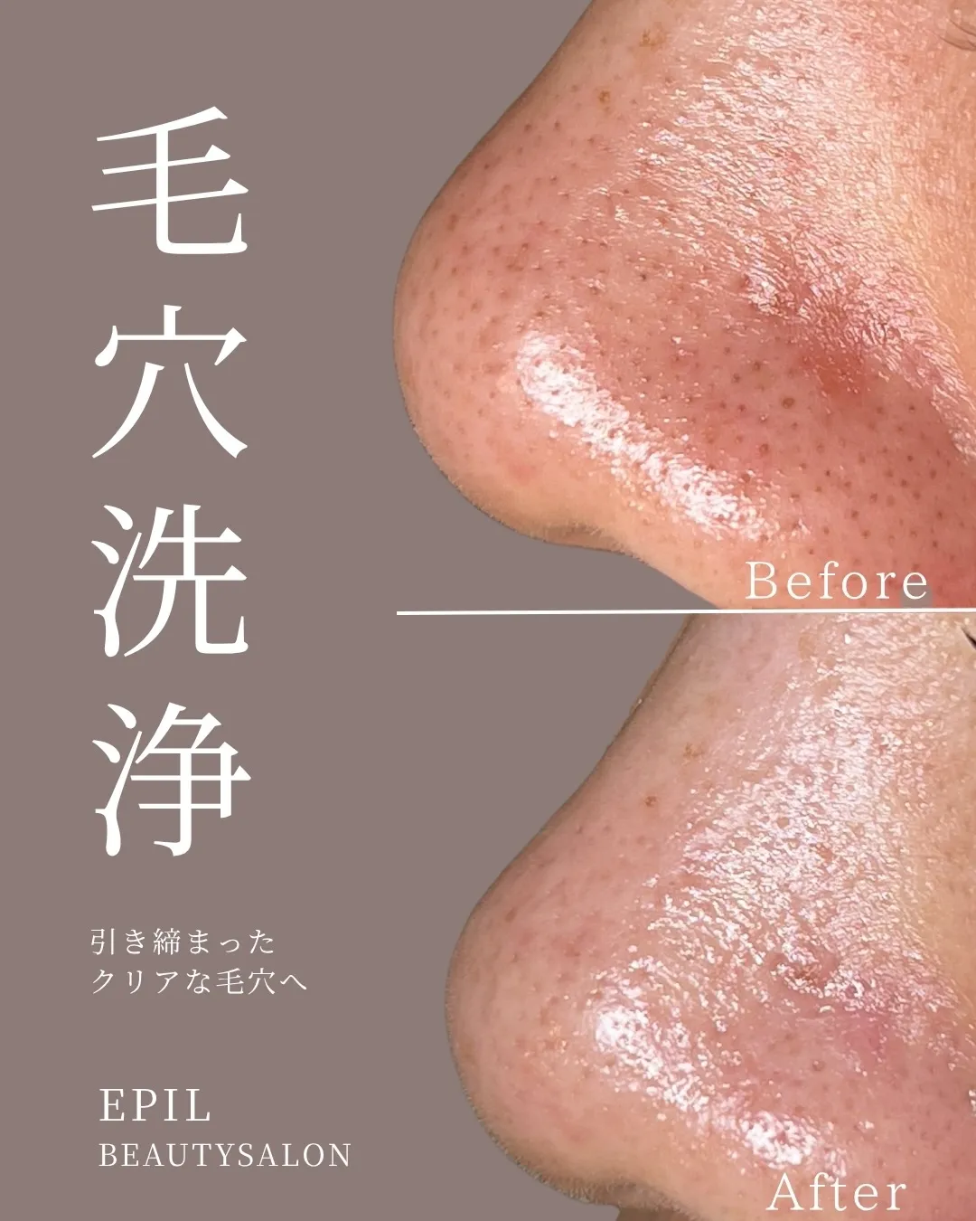 【毛穴肌質改善】Before⇆After /毛穴洗浄/20代...