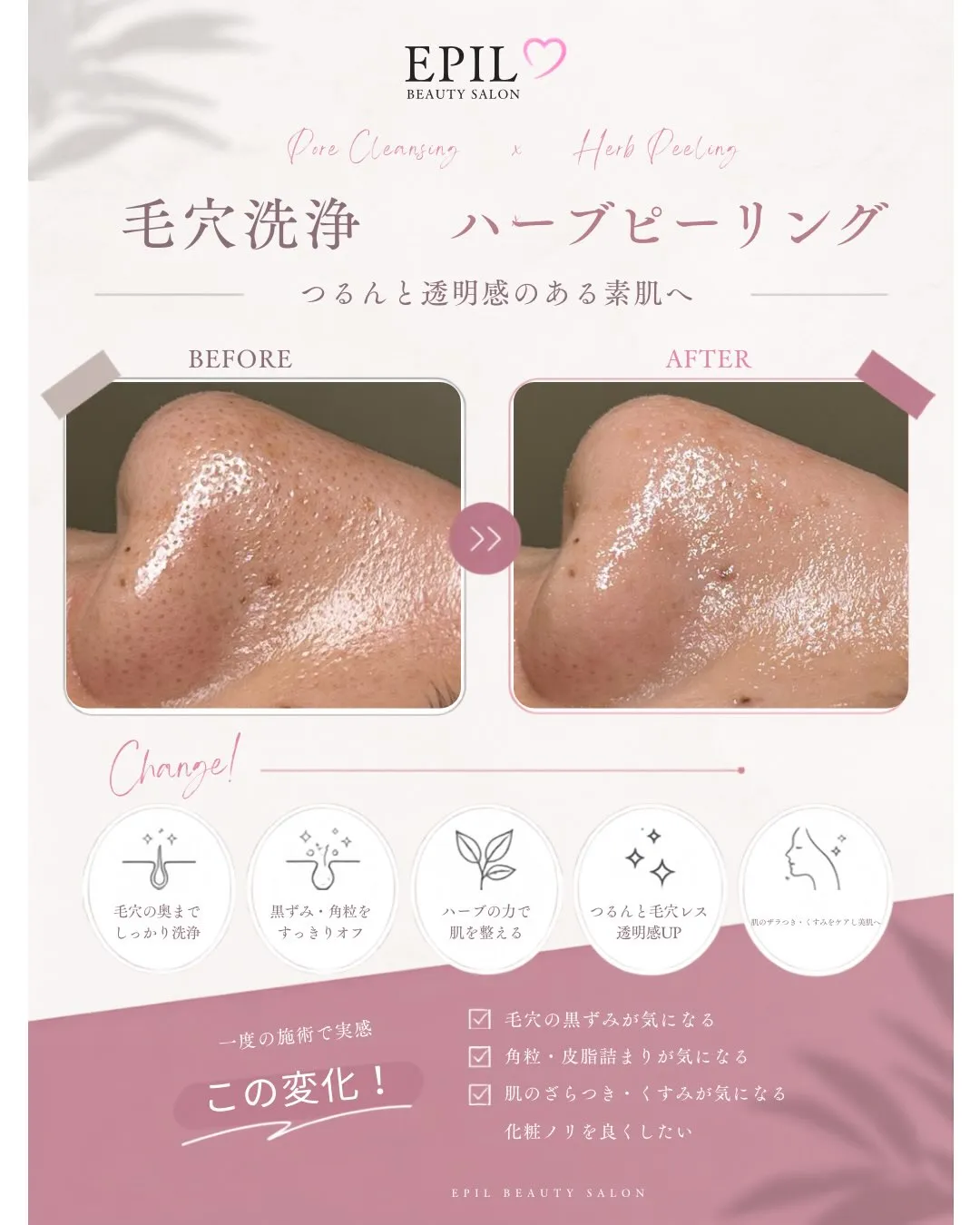 毛穴の黒ずみやザラつき、繰り返す肌荒れでお悩みの方へ。